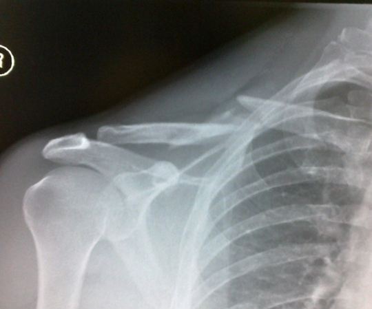 Lee P's broken collar bone